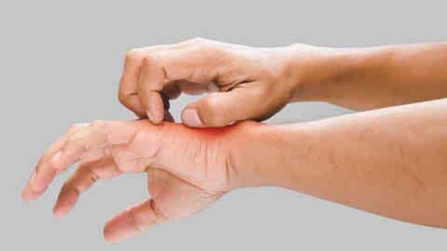 Kelebek hastalığı nedir, neden olur? Lupus hastalığı belirtileri ne, nasıl tedavi edilir?