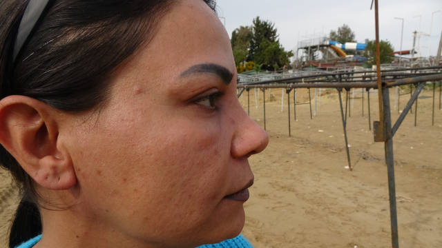 Kredi çekip estetik yaptırdı, hayatı güzellik uğruna kabusa döndü