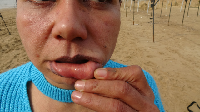 Kredi çekip estetik yaptırdı, hayatı güzellik uğruna kabusa döndü