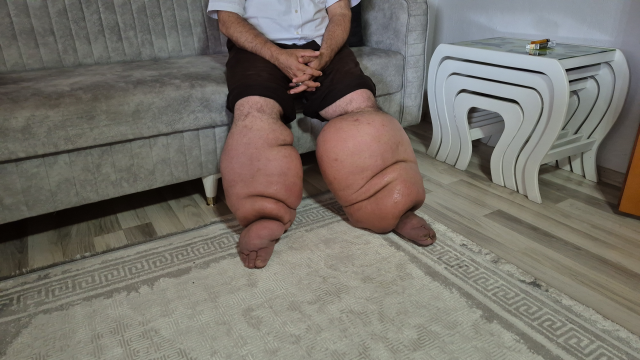 Fil Hastalığıyla Mücadele Eden Seyfettin Taşcı'nın Yardım Çağrısı