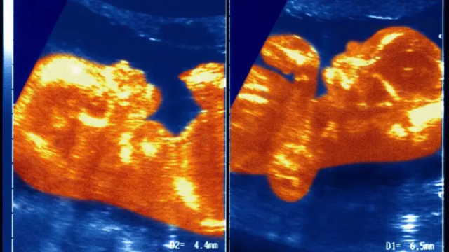 Tıp dünyasını şaşkına çeviren kadın: Erkek kardeşinden bir parça içinde dolaşıyor