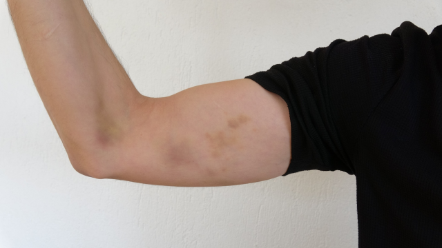 Rabia ve bozkurt işareti yaptı, dehşeti yaşadı! Belediye yöneticileri darp etti iddiası