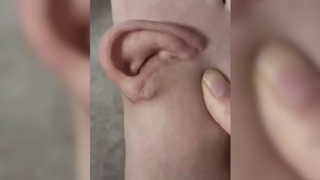 Eşi benzeri olmayan olay! Kulağını 5 ay ayağında taşıdı