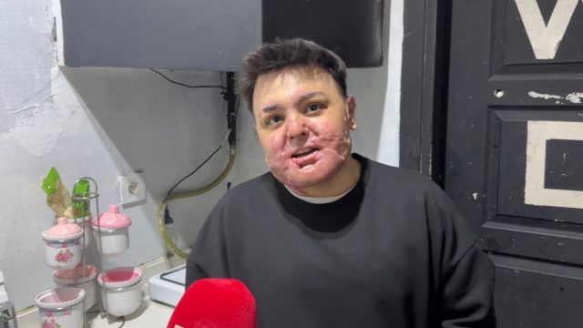 65 ameliyat geçirdi, 12 gün uyutuldu! Hayatı saniyeler içinde kabusa döndü