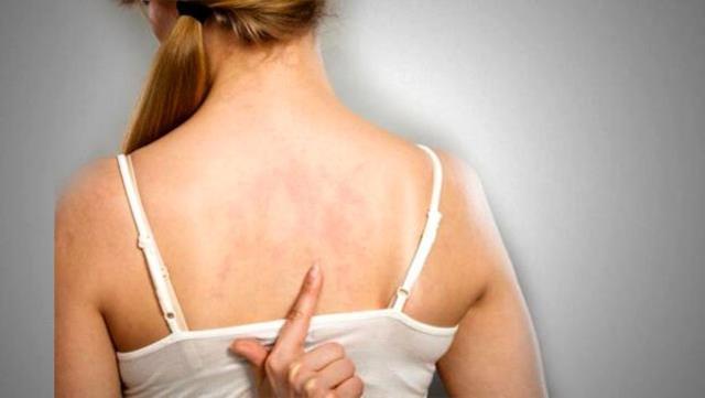 Egzama neden olur, bulaşıcı mı? Egzama nasıl geçer, evde neler yapılır?