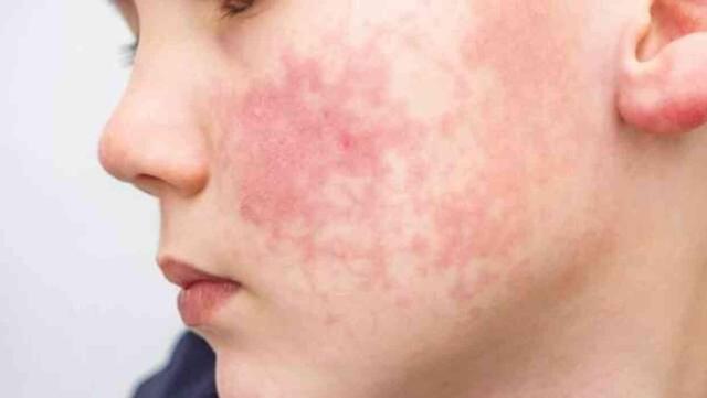 Beşinci hastalık nedir? Belirtileri ve tedavi yöntemleri nelerdir?