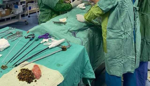 Doktor, güçlükle ikna ettiği hastanın safra kesesinden 2 bin adet taş çıkardı