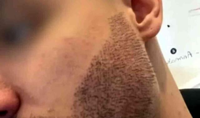 Türkiye'de sakal ektiren Fransız, intihar etti! Ameliyatı yapan kişi doktor bile değilmiş