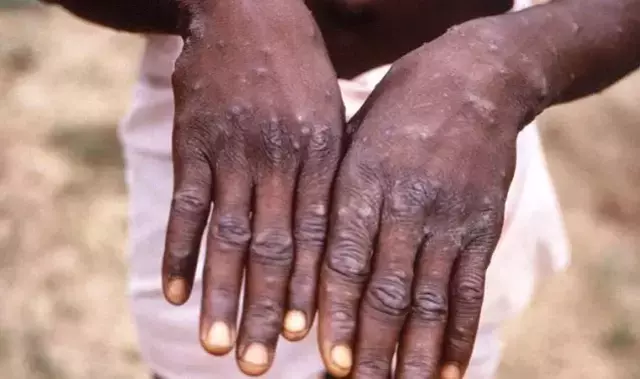 Dünyada hızla yayılan maymun çiçeği virüsü ile ilgili TTB'den uyarı: Küresel düzeyde önem verilmesi gerekiyor