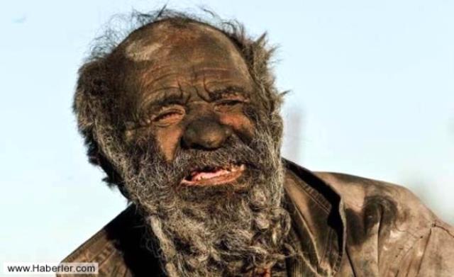 50 yıldan beri duş almayan adam doktorları şaşırmıştı, herkesi üzen bir haber geldi