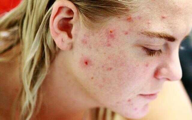 Rüyada sivilce görmek ne anlama gelir? Rüyada yüzde sivilce görmek nedir? Rüyada yüzde sivilce çıktığını görmek ne demek?