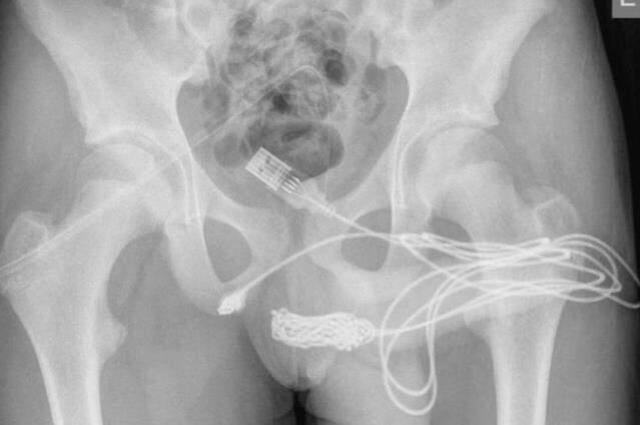 Annesinden günlerce gizledi! Penis boyunu ölçmek amacıyla içine kablo sokan çocuk hastanelik oldu