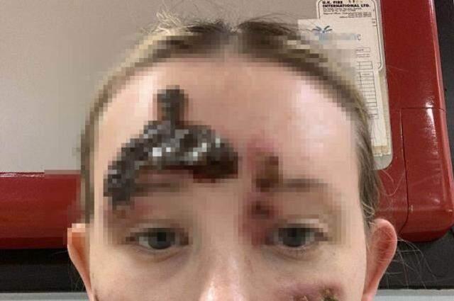 Güzelliği herkesin dilindeydi! Yüzündeki küçük sivilceyle başladı, artık aynaya bile bakamıyor