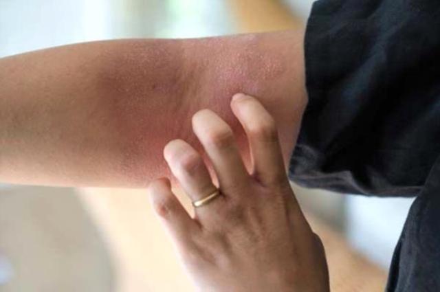 Egzama neden olur, bulaşıcı mı? Egzama nasıl geçer, evde neler yapılır?