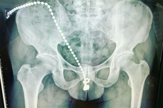 Mastürbasyon yaptığı sırada cinsel organına zincir sokan adam ölümden döndü