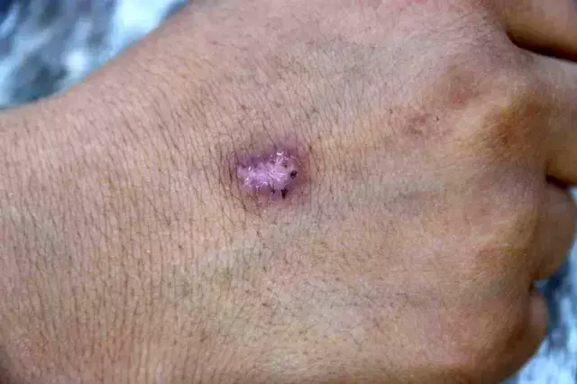 Küçük çocuğun vücudunda sigara söndürüldü; eski eşler birbirini suçluyor