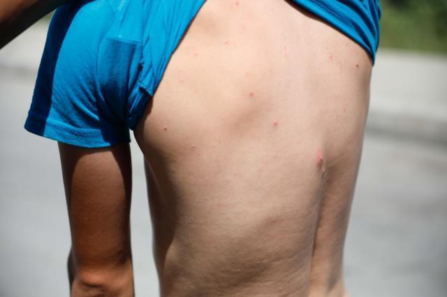 Zika virüsü taşıyan sivrisinekler İstanbul'da görüldü! Birçok mahalle tehlike altında