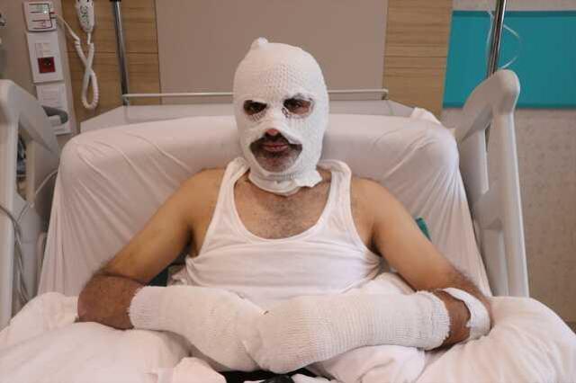 Grip hastası gaz kaçağını fark edemedi, yüzü ve elleri yandı