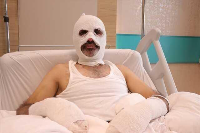 Grip hastası gaz kaçağını fark edemedi, yüzü ve elleri yandı