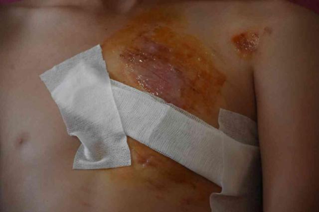 Açıkta kalan inşaat demiri küçük çocuğun göğsüne saplandı