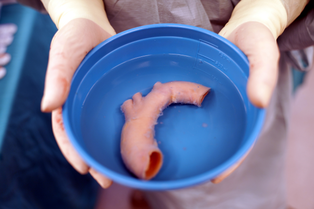 Kalbi 'yatay' doğdu, Türkiye'de ilk kez yapılan ameliyatla sağlık buldu; dünyada ikinci vaka