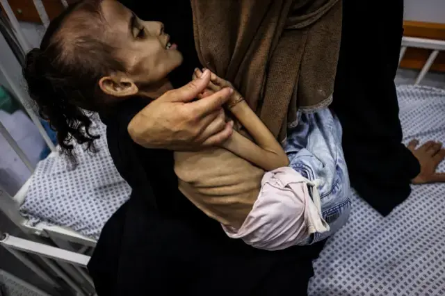 İnsanlığı utandıracak görüntüler! Gazzeli Meryem yavaş yavaş ölüyor