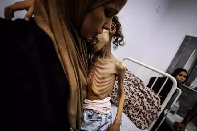 İnsanlığı utandıracak görüntüler! Gazzeli Meryem yavaş yavaş ölüyor
