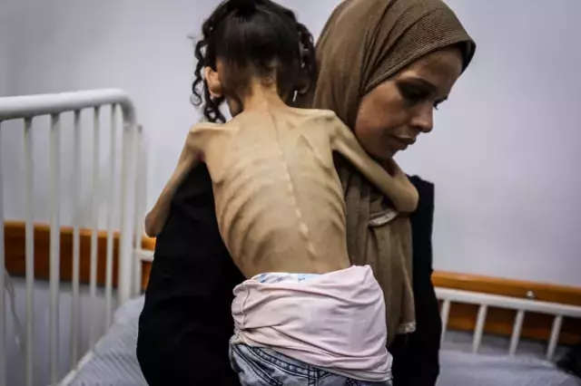 İnsanlığı utandıracak görüntüler! Gazzeli Meryem yavaş yavaş ölüyor