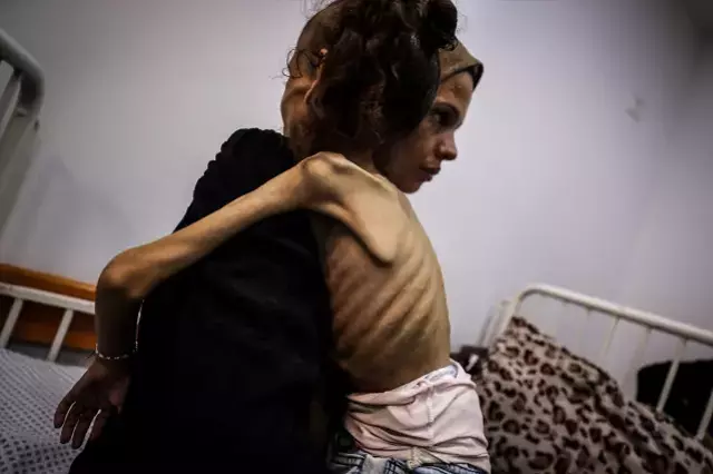 İnsanlığı utandıracak görüntüler! Gazzeli Meryem yavaş yavaş ölüyor