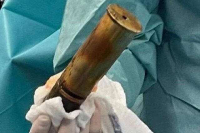 Şiddetli ağrıyla hastaneye başvuran adamın makatından 100 yıllık top mermisi çıktı