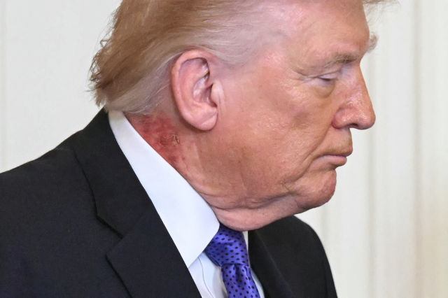 Trump'ın boynundaki kızarıklık hakkında doktorundan açıklama