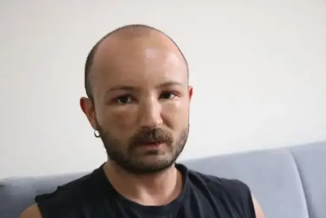 2 gün plaja gitti, başında nadir görülen sıcak ödemi oluştu