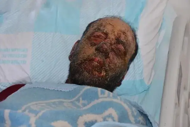 Covid-19 Geçiren Engelli Adamın Yüzü Tanınmaz Hale Geldi