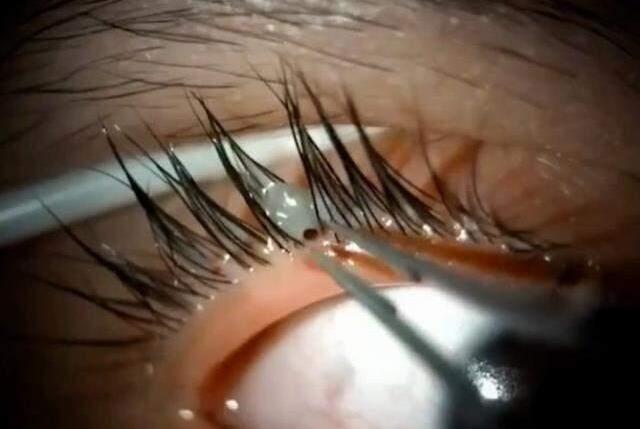 Tıp dünyasını şaşkına çeviren olay! Genç kızın gözünün içine kene girdi doktor bile çıkaramadı