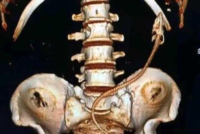 Kabız olan adam tedavi için yılan balığını seçti! Sonrası çok fena