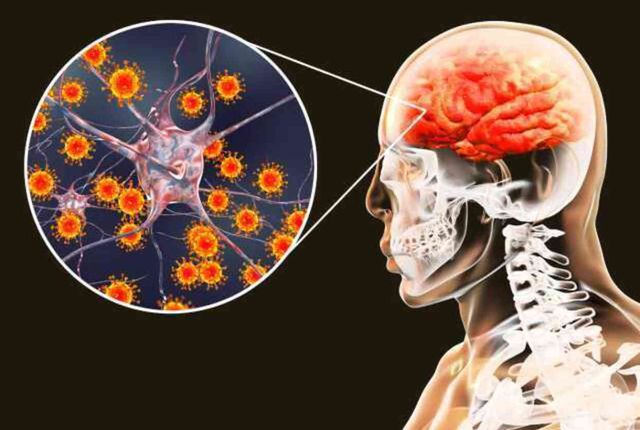 Menenjit nedir? Menenjite ne sebep olur?