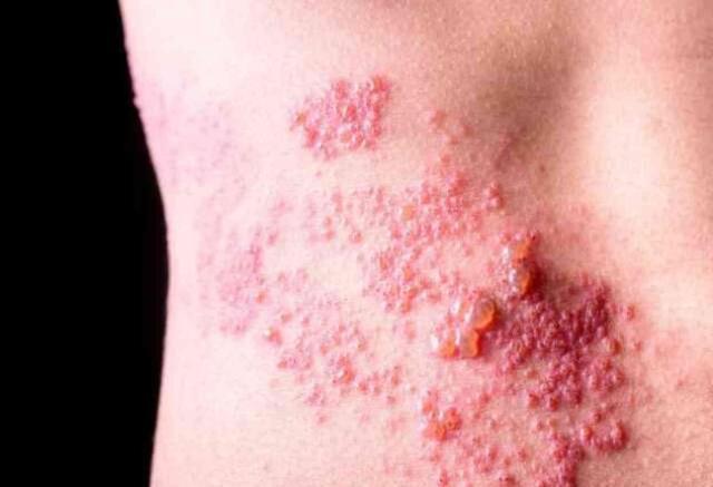 ZONA NEDEN OLUR? Zona (GECE YANIĞI) nedir, belirtileri neler?