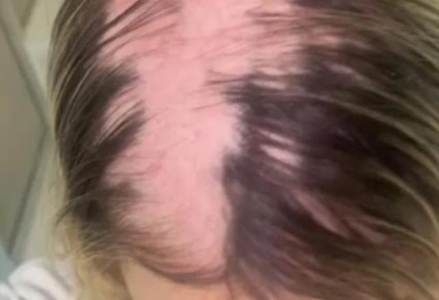 10 yıldır kullandığı doğum kontrol hapını bırakan kadın, her gün kabusu yaşıyor