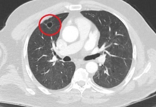 Dünya tıp literatüründe bir ilk! Koronavirüsün akciğer kanserini taklit ettiği tespit edildi