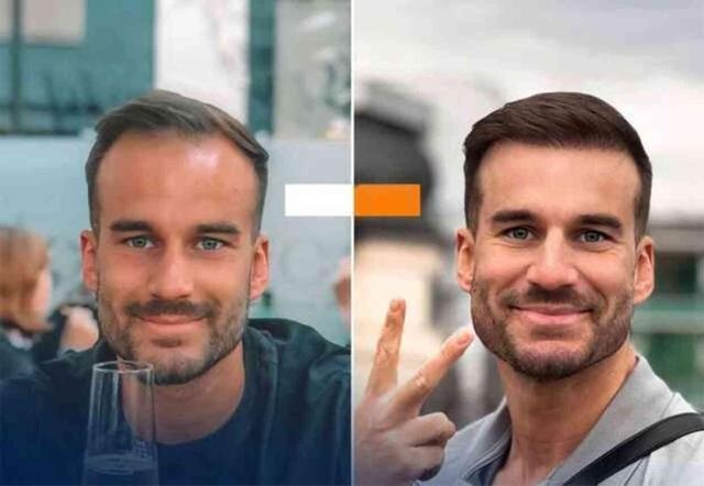 Türkiye, Saç Ekiminde Avrupa'nın Lideri Konumunda Yer Alıyor