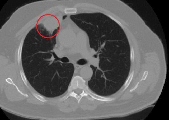 Dünya tıp literatüründe bir ilk! Koronavirüsün akciğer kanserini taklit ettiği tespit edildi