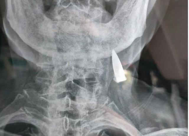 Baş ağrısıyla hastaneye giden 95 yaşındaki adamın röntgeni doktorları hayrete düşürdü