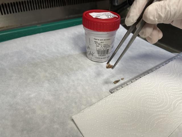 Kanser sanılan kadının soluk borusundan badem zarı çıkarıldı