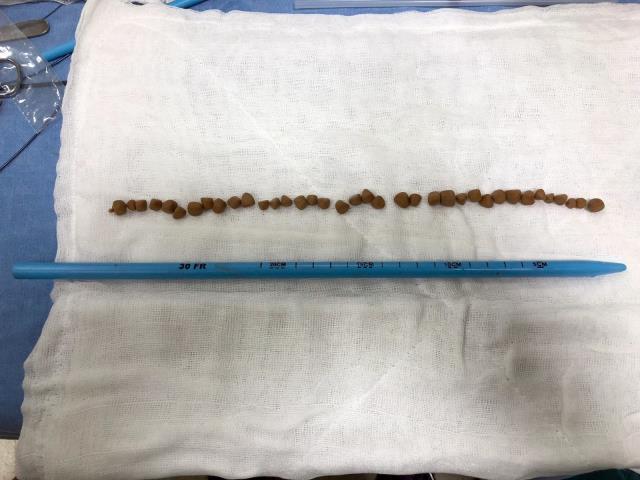 6 ayda 2 operasyon geçiren hastanın mesanesinden 66 adet taş alındı