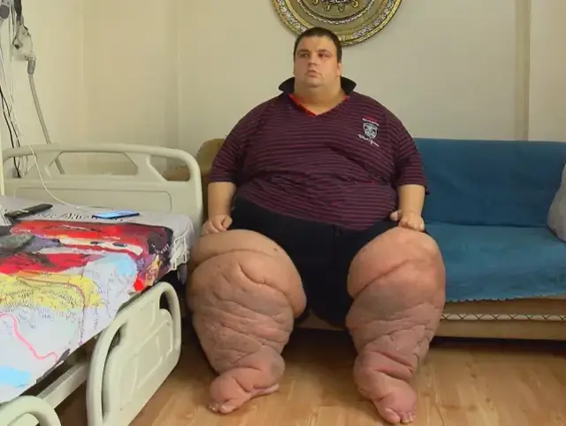 270 kilo Mehmet: 15 aydır evden çıkamıyorum, yardım edin
