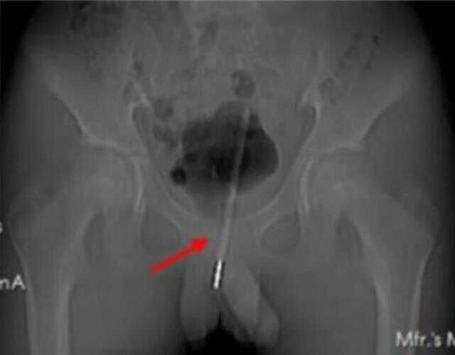 Merakına yenik düşen küçük çocuk cinsel organına soktuğu cisimle doktorları bile hayrete düşürdü