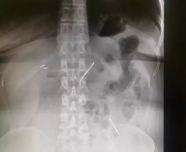 Karın ağrısı şikayetiyle gitti, 2 tane neşter yuttuğunu öğrendi