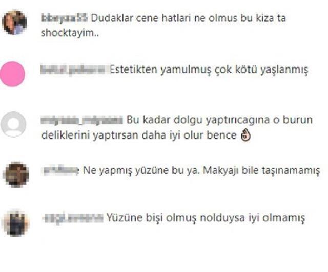 Oyuncu Bensu Soral estetik yaptırdı, son halini kimse beğenmedi