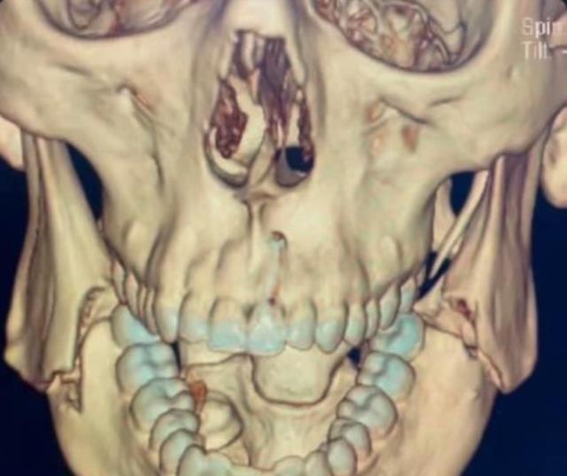 İnanılmaz ama gerçek! Ünlü boksörün çenesi dağıldı, yine de maçı bırakmadı