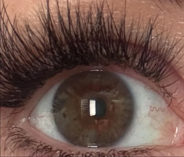 Yıldırım çarpan kadının göz rengi değişti